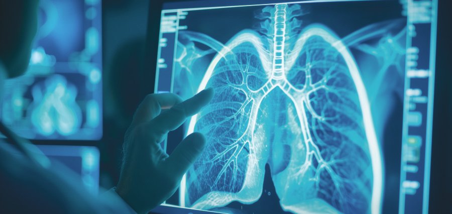 UCSF Researchers, Pneumonia